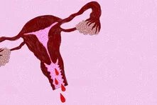 Illustration: Vor rosa Grund ist ein blutender Uterus.