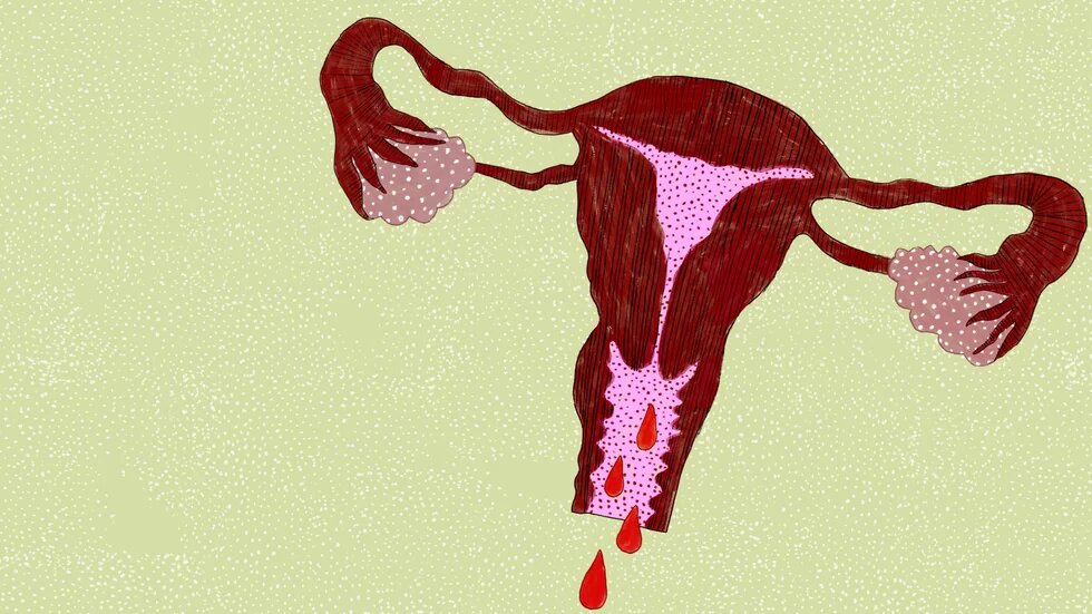 Illustration: Vor grünem Grund ist ein blutender Uterus.