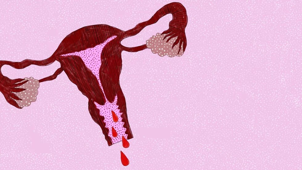 Illustration: Vor rosa Grund ist ein blutender Uterus.